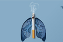 Akciğer Kanseri Sigara İçenleri Affetmiyor